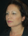 Full Facial Rejuvenation