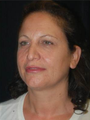 Full Facial Rejuvenation