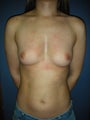 25 year old female breast augmentation