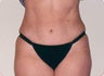 Tummy Tuck