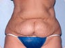 Tummy Tuck