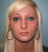 15 year old female patient 