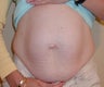 Tummy Tuck