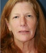 Facial Rejuvenation, comprehensive