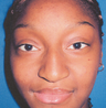 African American Rhinoplasty