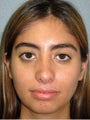 Hispanic Rhinoplasty