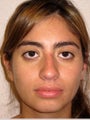 Hispanic Rhinoplasty