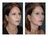 Lower Facelift and Necklift for Dramatic, Natural-Appearing Rejuvenation