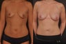 Fat Transfer