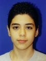 Otoplasty Ear Surgery - Male Child