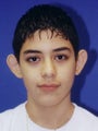 Otoplasty Ear Surgery - Male Child