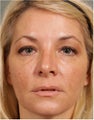 47 year old female treated for loss of volume under eyes, cheeks, and lips