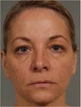 47 year old female treated for loss of volume under eyes, cheeks, and lips