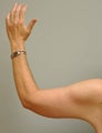 Arm Lift