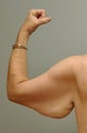 Arm Lift