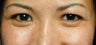 Crows feet