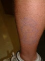 Tattoo Removal