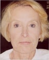 Liquid Face Lift using Botox, Pixel laser, Restylane, Botox and Platelet Rich Plasma
