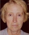 Liquid Face Lift using Botox, Pixel laser, Restylane, Botox and Platelet Rich Plasma