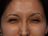 Botox for Crows Feet