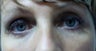 46 Year Old Female Treated for Droopy Eyelids