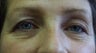 46 Year Old Female Treated for Droopy Eyelids