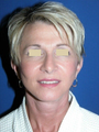 Facelift