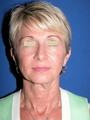 Facelift