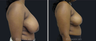 Breast Reduction