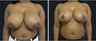 Breast Reduction