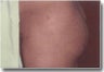 Male Buttock Augmentation 