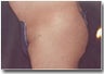 Male Buttock Augmentation 