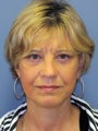 SMAS Facelift, LiteLift, Mini Lift