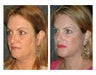 Facelift and Chin Implant for Dramatic Improvement in Jawline and Neck