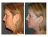 Facelift and Chin Implant for Dramatic Improvement in Jawline and Neck