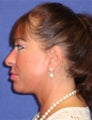 Facelift