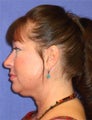 Facelift