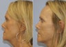 Facelift