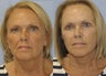 Facelift