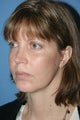 Facelift