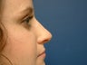 Rhinoplasty