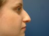 Rhinoplasty