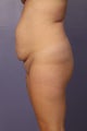 Butt Augmentation
