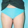 Liposuction
