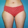 Liposuction