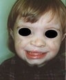 Infant who underwent surgery for a cleft lip and palate 