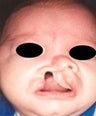 Infant who underwent surgery for a cleft lip and palate 