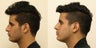 Revision rhinoplasty after 2 nasal fractures