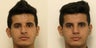 Revision rhinoplasty after 2 nasal fractures