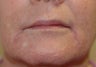 Juvederm